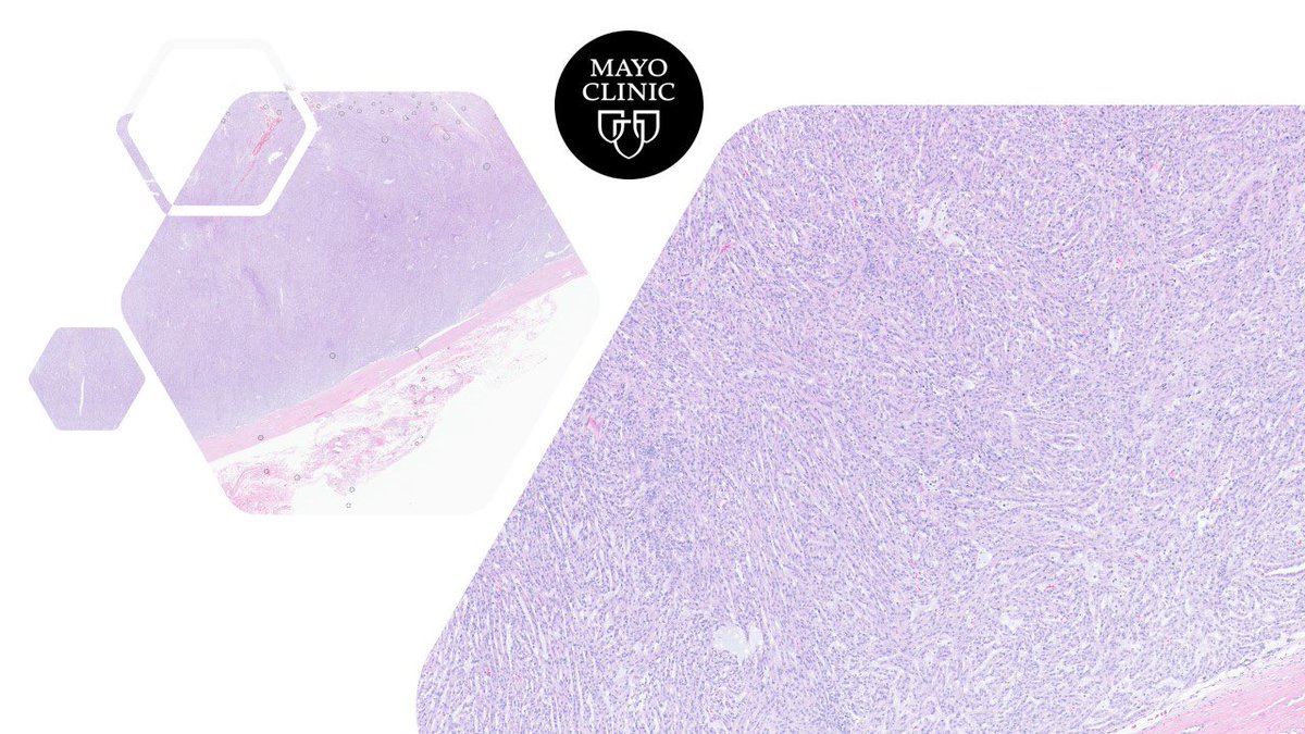 MayoPathology's tweet photo. ⚠️Renal mass⚠️, middle-aged woman 👩 https://t.co/ueB90shPWW @theglasspusher @rajalbshah @FridaRosenblum @kis_lorand @MayoClinicPath @johncheville @ZhaiJim @selveras_stains @Williamson_SR @Shounak_Gupta @KMirza @bonnie_choy @AMubeen_Path #GuPath #patht #pathology @AzizaNassar2 https://t.co/xgmqqkzhdx