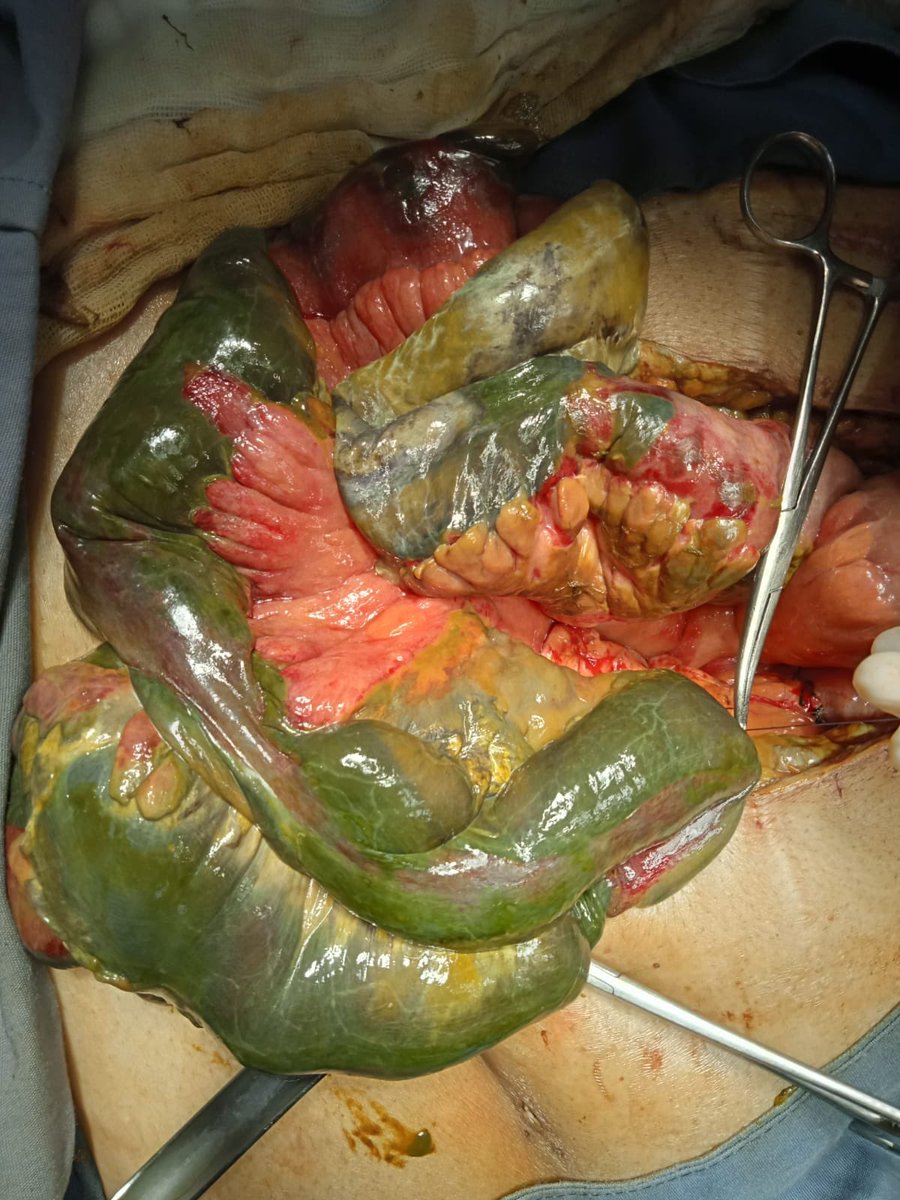 Halstedwi's tweet image. Hay cirugías que sabes que acabando te va a dar sed… de la mala
#coolturaquirurgica #cirugia #cirujanos