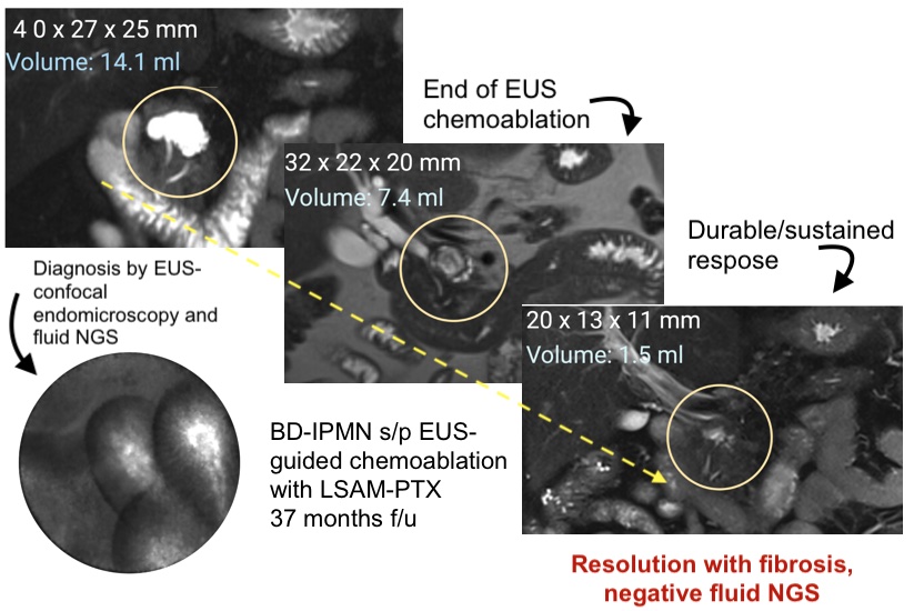 Somashekar Krishna, MD, MPH (@som_krishna) on Twitter photo EUS-guided chemoablation with LSAM-PTX (NanoPac). Excellent resolution of a 4cm BD-IPMN. 
Immediate & a year later - continued durable response.
Confident ablation > possible with a highly accurate diagnosis of cysts by EUS-endomicroscopy (nCLE) & fluid molecular analysis (NGS) EUS-guided chemoablation with LSAM-PTX (NanoPac). Excellent resolution of a 4cm BD-IPMN. 
Immediate & a year later - continued durable response.
Confident ablation > possible with a highly accurate diagnosis of cysts by EUS-endomicroscopy (nCLE) & fluid molecular analysis (NGS)