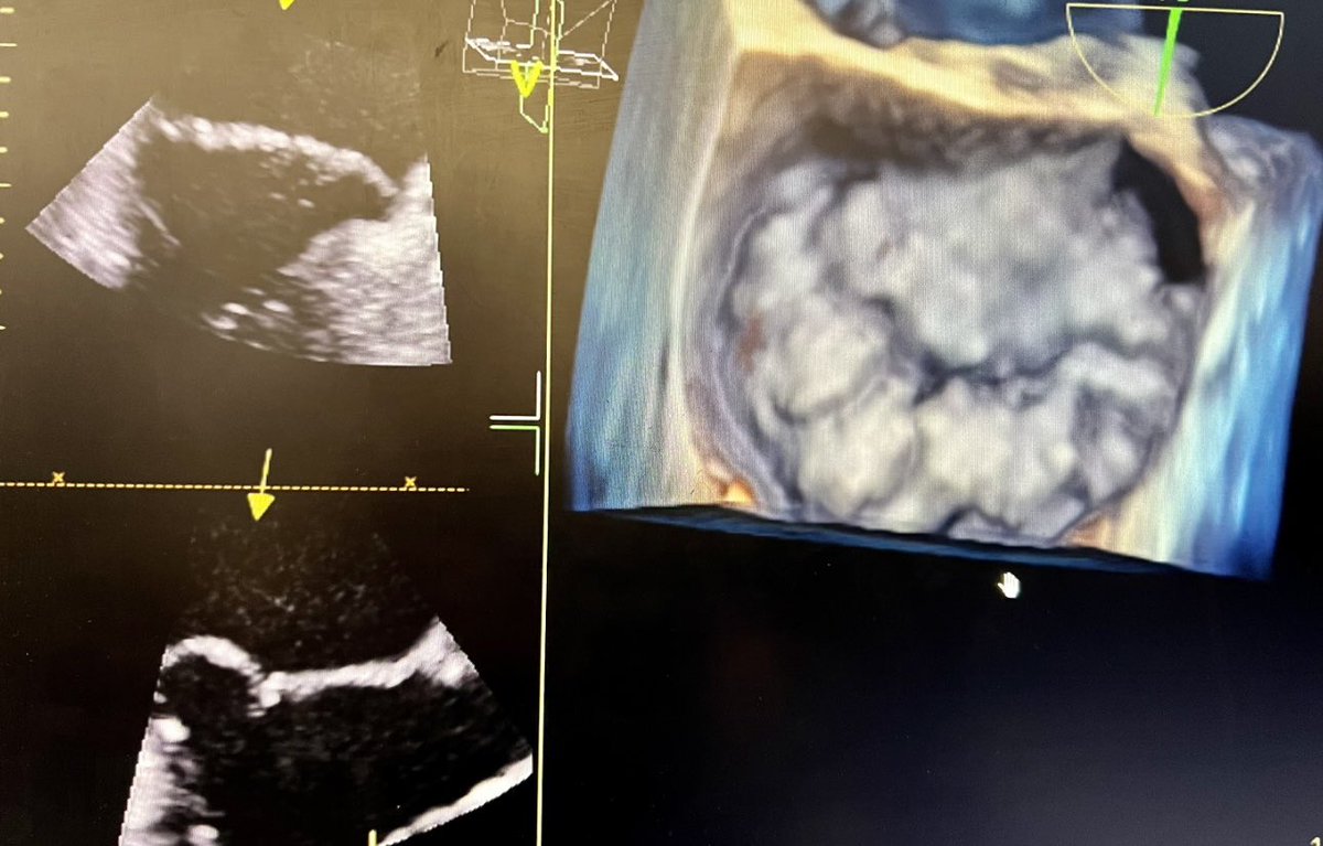Thomas Waggoner (@drtomwaggoner) on Twitter photo Congratulations to our phenomenal TMC Research & Structural Heart Teams for successfully performing the first HighLife EFS TMVR implant in ARIZONA and the first overall in the greater SW! #Extremely proud! #innovationleader #growthmindset <a href="/TAVRBot/">TAVR Bot</a> <a href="/PradeepYadavMD/">Pradeep Yadav</a> <a href="/PhilGenereuxMD/">Philippe Genereux</a> Congratulations to our phenomenal TMC Research & Structural Heart Teams for successfully performing the first HighLife EFS TMVR implant in ARIZONA and the first overall in the greater SW! #Extremely proud! #innovationleader #growthmindset <a href="/TAVRBot/">TAVR Bot</a> <a href="/PradeepYadavMD/">Pradeep Yadav</a> <a href="/PhilGenereuxMD/">Philippe Genereux</a>