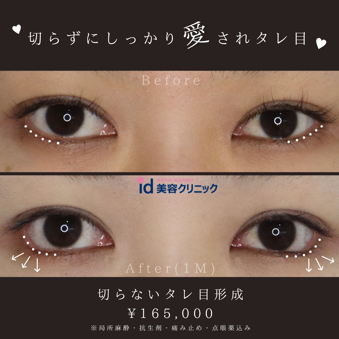 IdclinicG's tweet photo. 切らないタレ目形成についてご紹介🧑🏻‍⚕️

---------------
切開せずに瞼の裏側から糸を留めてタレ目形成する方法です。傷が残りにくく腫れや内出血も少なく、回復が早いことが特徴です😊
---------------

モニター価格～
目元のみ 【￥148,500】
お顔全体  【￥132,000】 https://t.co/0JEqfSkCTD