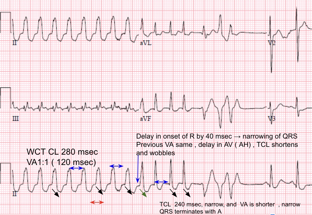 <a href="/NikhilShahMD/">Nikhil Shah, MD</a> <a href="/ecgrhythms/">Arnel Carmona</a> LIkely AVRT with left-sided AP ( 0300 Mitral annulus)  with dual AVN physiology and rate-related LBBB resulting in WCT, wobble, change to NCT and termination. The VA shortens when QRS shortens; Great ECG, thanks for sharing ! <a href="/EPeeps_Bot/">EP_Bot</a>