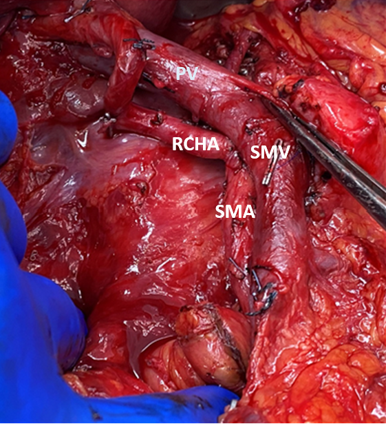 Chris_SHLim's tweet photo. Cool demonstration of the replaced CHA coming off the SMA. Anyone else feel like these are more common than classically taught? 
#whipple #hpb https://t.co/teaPxm3Fga