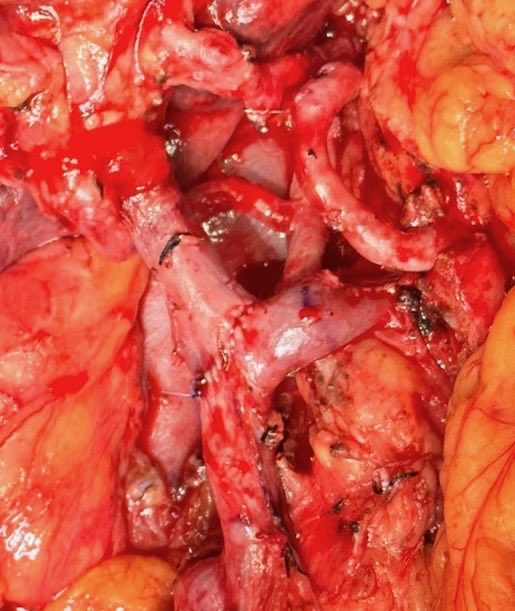 Our Pancreatic Fellow Dr Tamara Gall’s handy work. Aberrant right hepatic artery. Splenic are Terry divested Partly subadventitial. Junction of SMV/ PV- sppenoc vein resected and reconstructed- superb anastamosis.