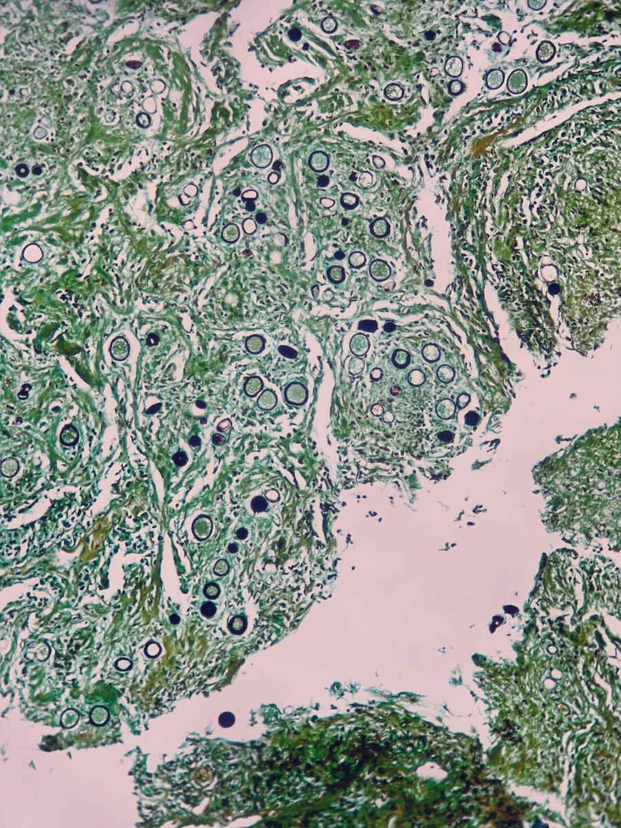 Pathowan's tweet image. Pulmonary Coccidioidomycosis. 🔬🦠🍄
#PathTwitter #PulmPath #PathBugs