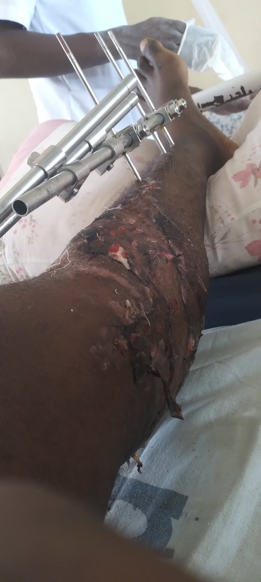 Gery_Gerrald's tweet photo. As I'm turning 27 today, haya ndiyo niliyoyapitia tokea tarehe 23.10.2022 mpaka leo, lakini mimi ni nani nisiseme "ASANTE MUNGU" kwa kunipa uzima mpaka Leo..

NB: PICHA ZINATISHA KIDOGO.

Ni hivi, usiku baada ya derby ya Simba v/ Yanga nilikua narudi nyumbani, kufika maeneo ya 👇🏿 https://t.co/ewU38k2cpd