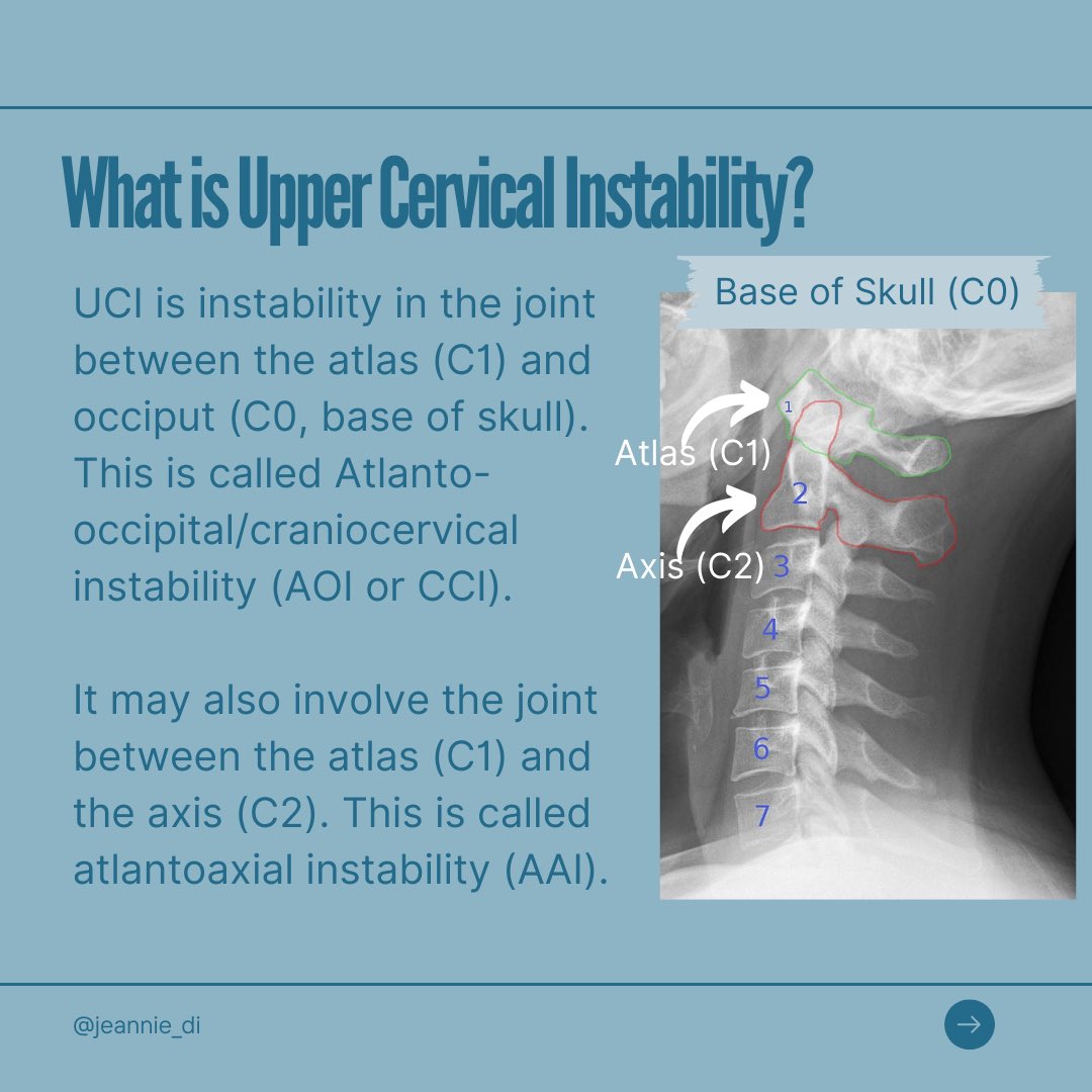 jdibon's tweet photo. New research paper on cervical instability. Couple of key points from the paper. Until now there hasn’t been any ‘gold standard’ or evidence based treatment info. Huge thx to all the people who contributed to this. #hypermobility https://t.co/x34pO2mG52