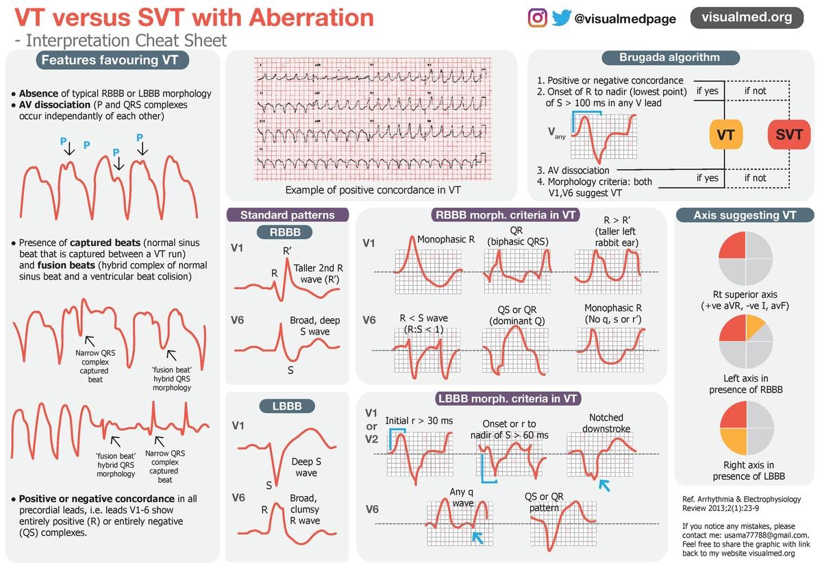 VT versus SVT with aberration <a href="/Visualmedapp/">Visualmed: Clinical Trials</a> #MedTwitter