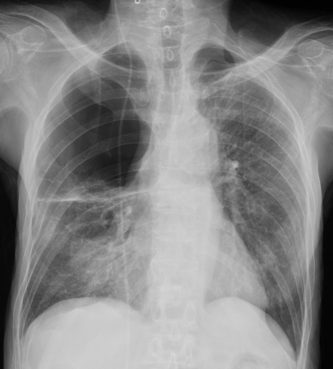 DoctorFigueroa's tweet image. 74 y.o. Broken hip after falling in his own house. Chest pain, no dyspnea.

Next step?

#thoracic #radiology #xray #elearning