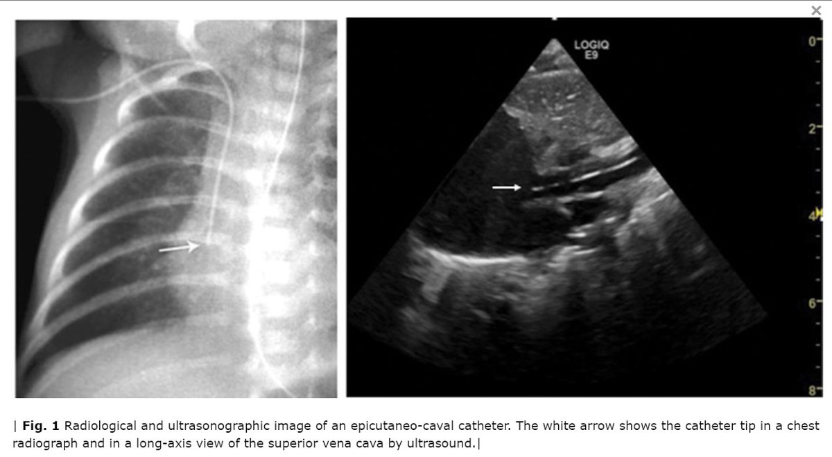 NICU_Musings's tweet photo. It appears ultrasound placement of PICC lines in neonates should be the goal in all centers.
Malposition in 64.8% using x-ray vs 13.2% with ultrasound.
https://t.co/nm1Zy9iQM4
#neoTwitter #radiology https://t.co/WTNpoMyqka