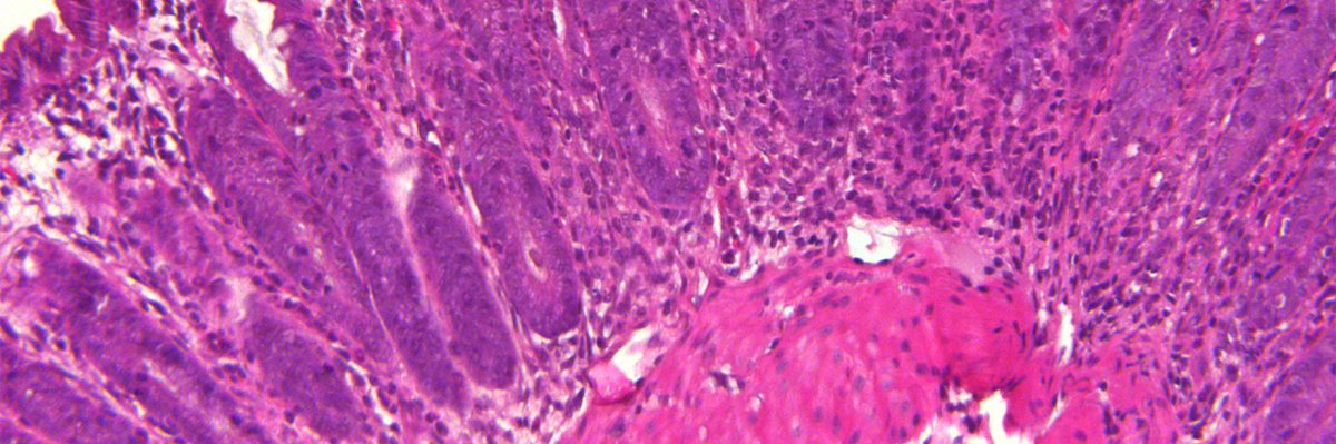 SciImmunology's tweet photo. Tested in mice and cells from patients with #Crohns disease, a potential #IBD treatment—combining an engineered peptide and FDA-approved rapamycin—lured out and depleted T cells that react excessively to gut bacteria.

Read the 2020 work: https://t.co/QeKTwUQdjL @UABSOM https://t.co/Xh1gaXjLDo