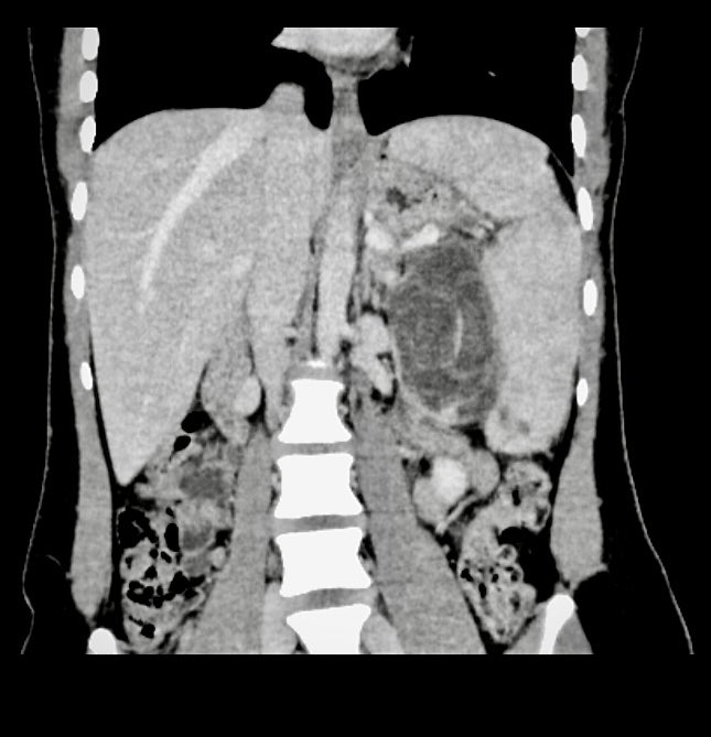 Hassaan Bari (@dr_hassaanbari) on Twitter photo Ended week on a high note 🔆
Lap Distal Pancreatectomy for an 8cm MCN in a 24👧
Thrombosed splenic vein >chunky short gastrics🩸
WWYD; medial to lateral or lat to med or a combination?
<a href="/IHPBA/">IHPBA</a> <a href="/SOS_Pk/">Surgical Oncology Society Pakistan. SOSPK</a> <a href="/hpb_so/">SoMe4HPB</a> <a href="/HpbLounge/">HPB Lounge</a>
#MedTwitter #Cancer #surgeons #PancreaticCancer #liver Ended week on a high note 🔆
Lap Distal Pancreatectomy for an 8cm MCN in a 24👧
Thrombosed splenic vein >chunky short gastrics🩸
WWYD; medial to lateral or lat to med or a combination?
<a href="/IHPBA/">IHPBA</a> <a href="/SOS_Pk/">Surgical Oncology Society Pakistan. SOSPK</a> <a href="/hpb_so/">SoMe4HPB</a> <a href="/HpbLounge/">HPB Lounge</a>
#MedTwitter #Cancer #surgeons #PancreaticCancer #liver