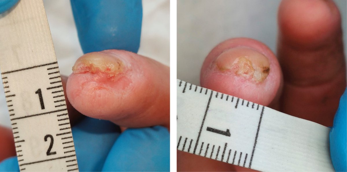 aswcjournal's tweet image. DID YOU KNOW? 
Topical administration of #Cannabidiol is a safe and effective tool to treat pain related to #DigitalUlcers in patients with #Scleroderma and improve ulcer healing and patient quality of life. #CBD bit.ly/3IFSNCp