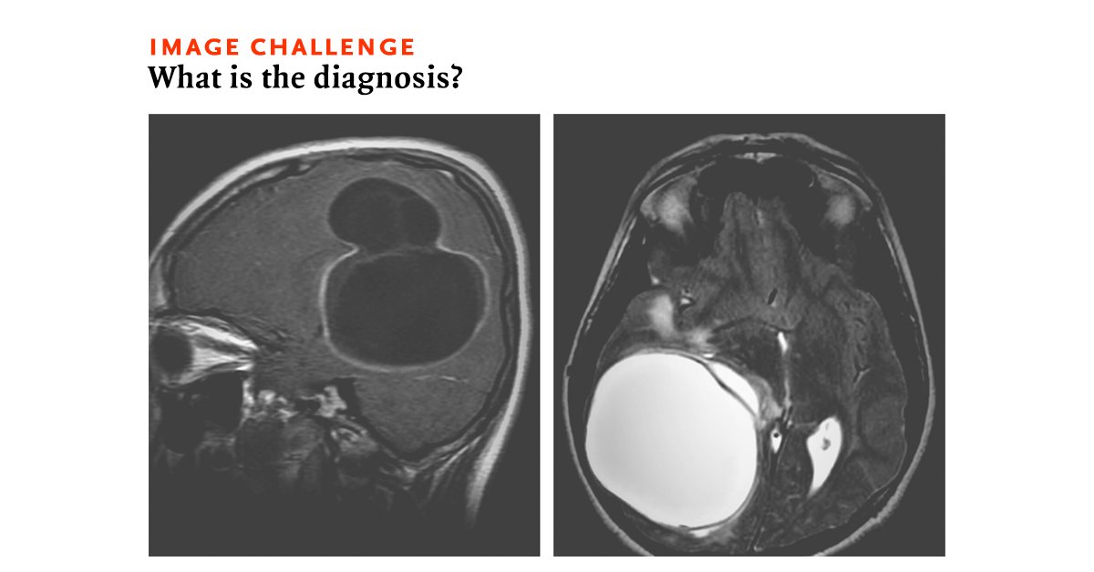 A previously healthy 14-year-old boy who lived on a farm presented with a 1-month history of episodic headaches associated with vomiting. What is the most likely diagnosis? nej.md/2Ku5WxD
