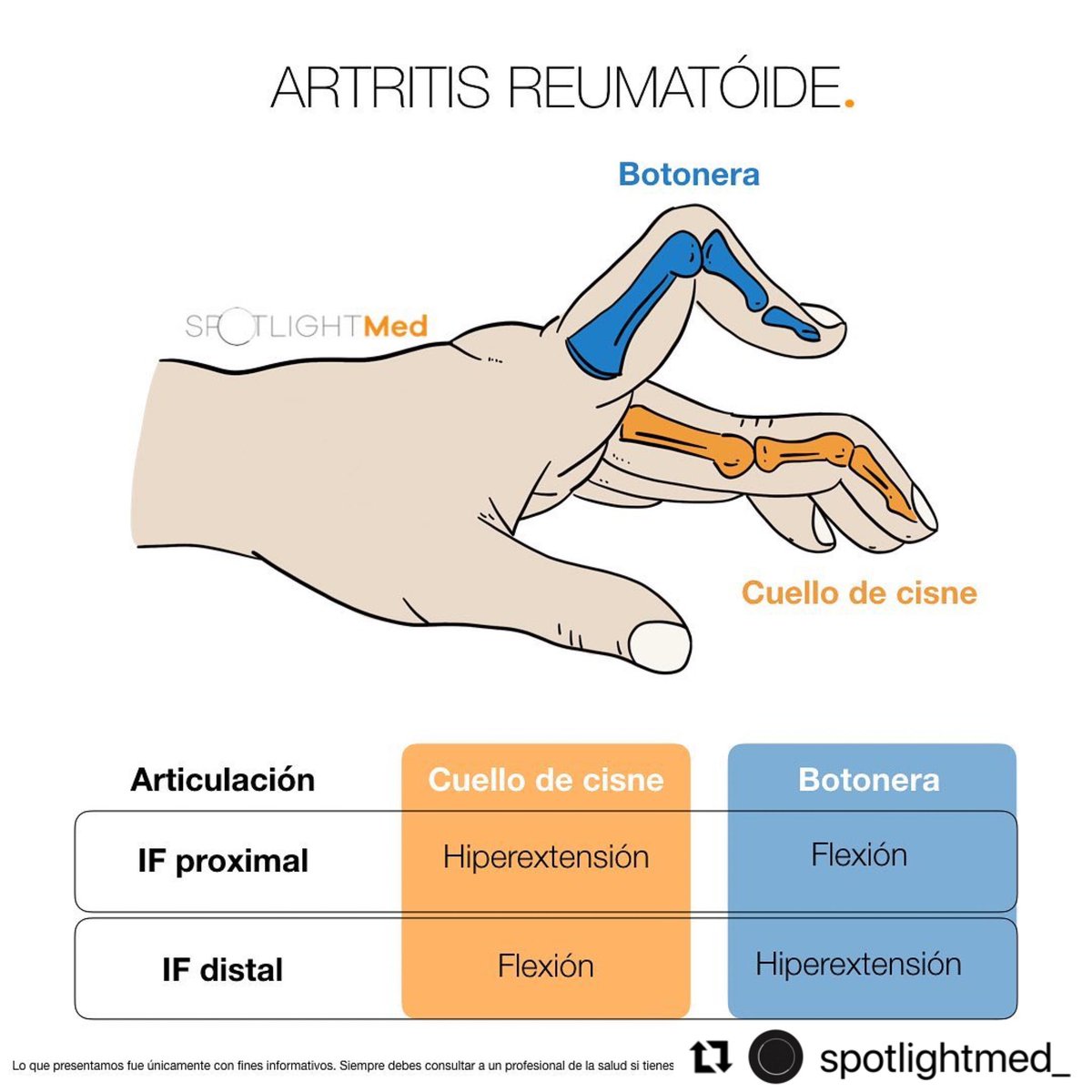 Artritis reumatoide 🖖🏼 #spotlightmed #spotlightmedicine #MedCOACH #Medschool #medlife #medicina #enarm #reumatologia #enarm2023 #mip #mpss #medstudent #medstudentlife #artritisreumatoide