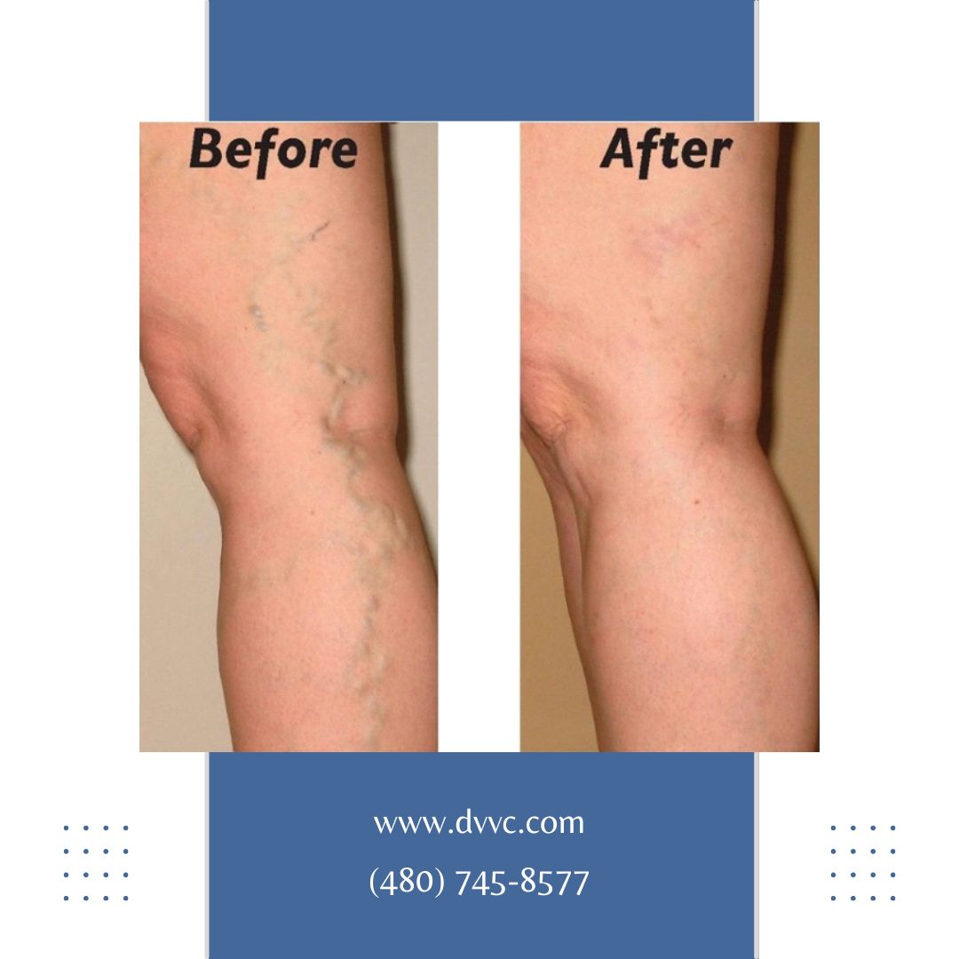 DiscoverVein's tweet photo. Get your veins in shape before summer! Nobody wants to see road maps on your legs. So, call us for a consultation today at (480) 745-8577.
#veinspecialists #veinsurgeon #veinandvascular #vascularspecialists #legpain #chandler #reels #videoreels #facebookreels https://t.co/03yM6664fj