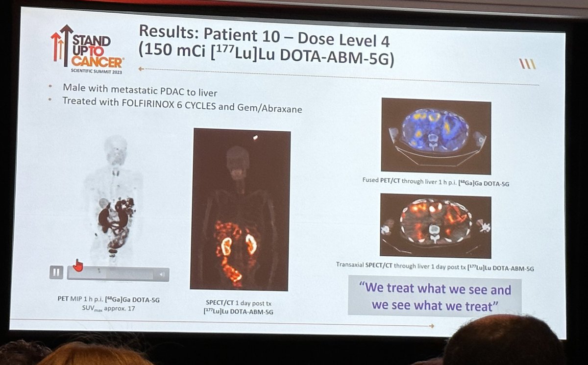 BernardAFox's tweet photo. 2) Molecularly Targeted Radionuclide therapy 4 adv or met #PDAC - #68Ga #177Lu /ph1 trial Safety & efficacy of theranostic pair 4 #Pancreatic #Cancer supported by @lustgartenfdn & @SU2C presented @ #SU2CSummit2023 @PanCAN @letswinpc @PancreaticCanUK @PanCanResearch @AACR https://t.co/OKHeyoqqw0