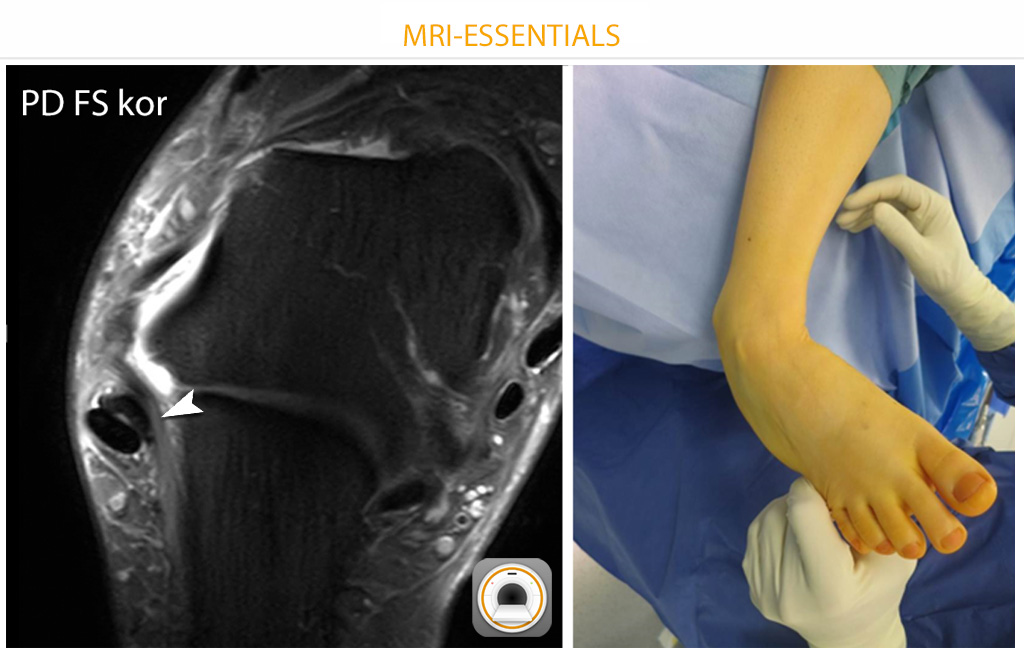 In cases of chronic ankle instability (esp. subtalar instab.), MRI can be misleading. In this case, edema along the calcaneofibular lig. was the only finding. The surgical image shows significant instability (thanks to Dr. Martin Jordan!).
#mskrad #orthotwitter #radres #radiology