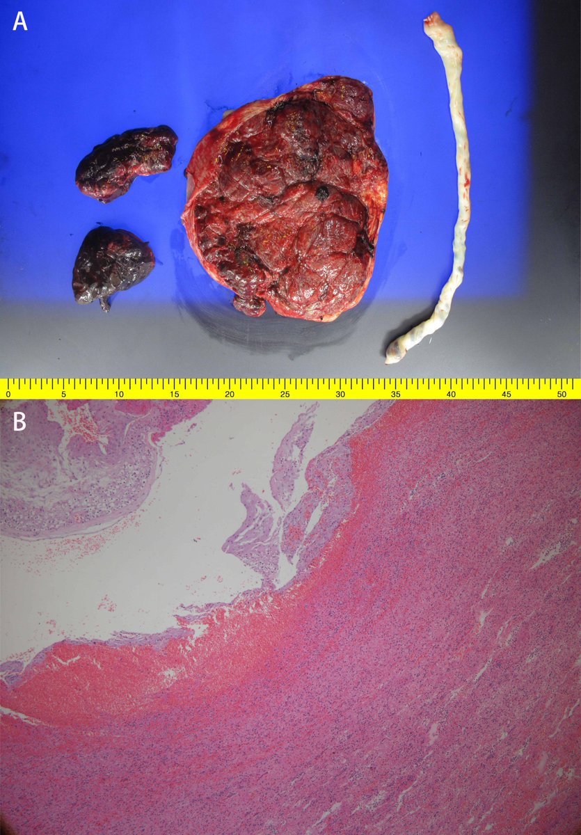 AdelaHim's tweet photo. #CEOG #IMR_Press; #OpenAccess
Welcome to read this article from journal Clinical and Experimental #Obstetrics &amp; #Gynecology:
#Placental Abruption with Subamniotic #Hemorrhage: A Case Report

👉 Please see more detail at:
https://t.co/OWKji62XMo https://t.co/YXDBbYowRh