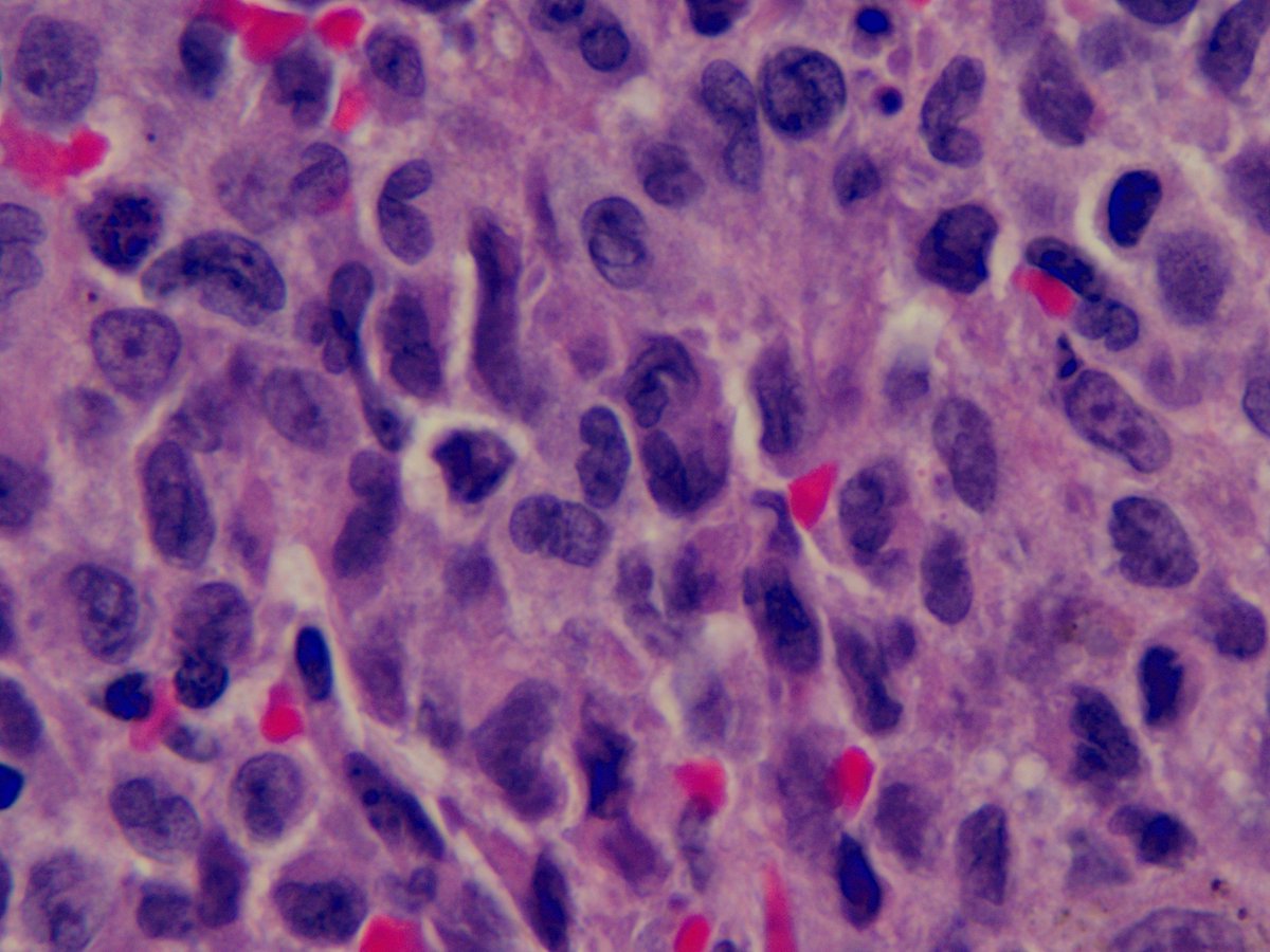 Langerhans cells: note the convoluted nuclear contours, like the kernel of a walnut: From a case of pulmonary Langerhans cell histiocytosis  kikoxp.com/posts/20337