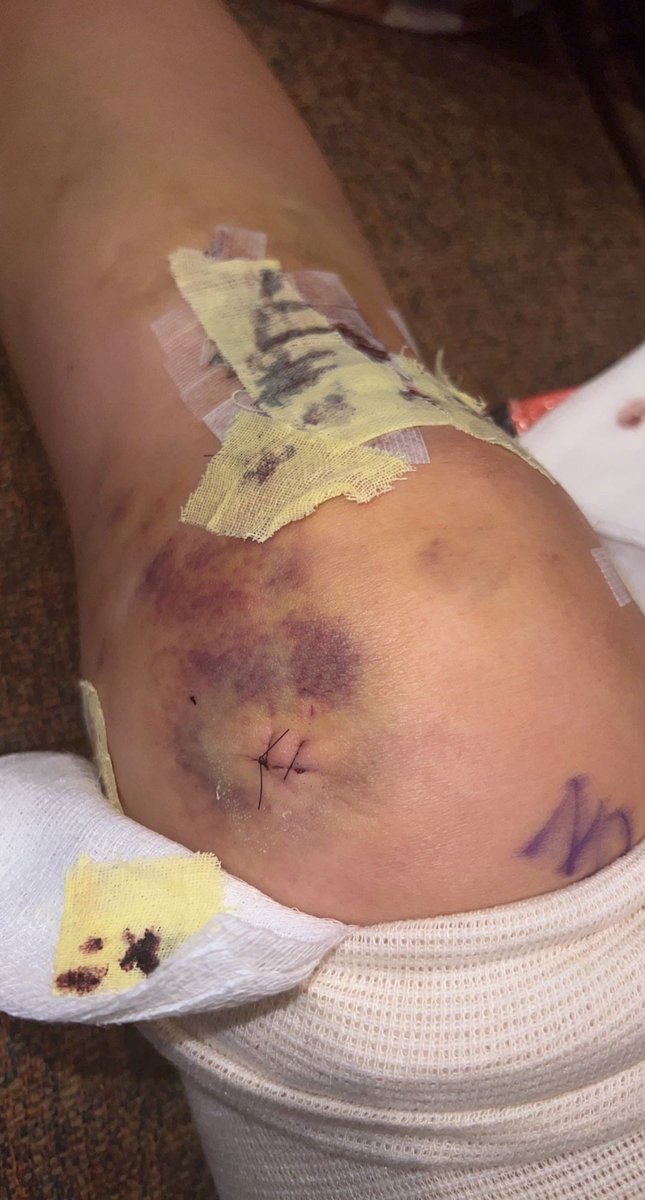LWillems25's tweet photo. Surgery was Dec 14th for ACL/Meniscus tear for @_kelseywillems_  @AugieWBB player. Physical Therapy appointments and rehab for 6 weeks. She is down to one crutch and back to school  to finish reovery with her athletic trainer Go Vikes! https://t.co/8WupXeb8F0