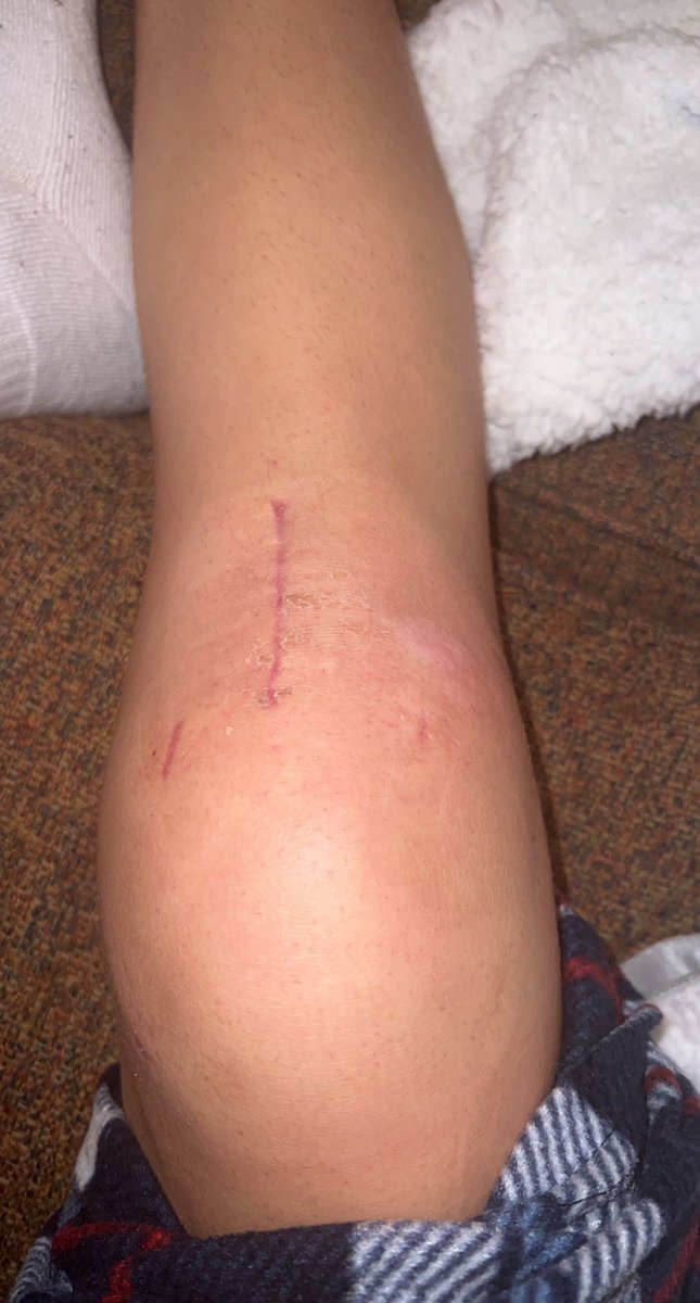 LWillems25's tweet photo. Surgery was Dec 14th for ACL/Meniscus tear for @_kelseywillems_  @AugieWBB player. Physical Therapy appointments and rehab for 6 weeks. She is down to one crutch and back to school  to finish reovery with her athletic trainer Go Vikes! https://t.co/8WupXeb8F0
