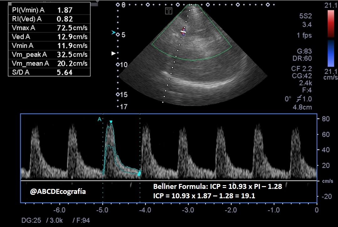 Spectral recording of the middle cerebral artery with a pattern of hypoperfusion and high resistance compatible with intracranial hypertension, in a neurocritical patient. Non-invasive ICP by Bellner formula / 
#NeuroCritCare, #ICU, #WINFOCUS, #POCUS, #ASARUC