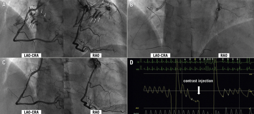 u_kaul's tweet photo. coronary perforation caused by coronary angiography https://t.co/n2vrEEeadq
