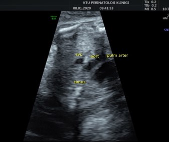 gan_aries's tweet photo. The researchers at Karadeniz Technical University published an article in @CEOGjournal.  

This article is about 
#Dichorionic_diamniotic_pregnancy
#Fetal_thymus_volume
#Preterm_labor
#Twin_pregnancy

You can read the full text at:
https://t.co/iYW6ISZXQk https://t.co/wbjLOwbCsx