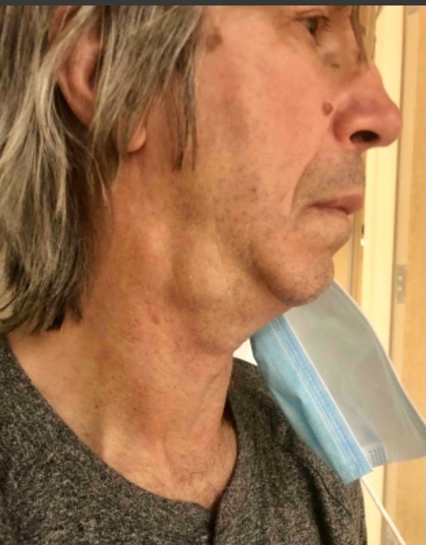 steve_carlson17's tweet photo. This was the cancer that radiation and chemo put in remission👊 but does anyone else find it ironic #17 teeth being extracted this AM from radiation damage I am one step closer to getting my smile back #keepprayerscoming  #nocoffee #getitover #readytolive https://t.co/jnII9VrHWE