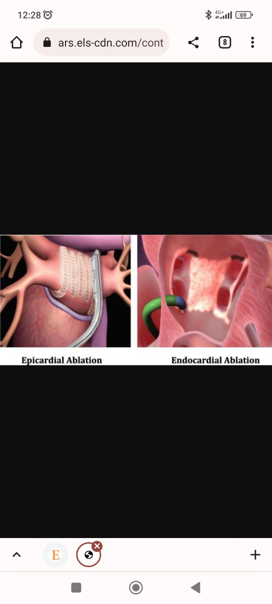 Iigosainz1's tweet photo. The Cruces Univeristary Hospital performs the first hybrid Endo-Epicardic Ablation procedure with the Convergent system in Spain in a patient with long-standing AF.#EPeeps,#CardioTwitter, https://t.co/5bB0Gr8BFi
