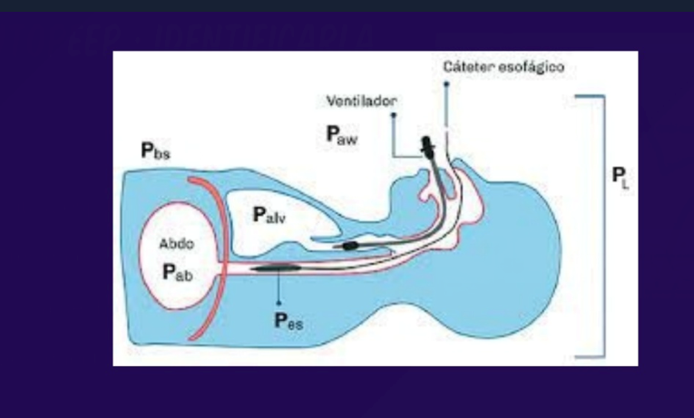 Hoy en #sesiónclínica la Dra. #LauraAbella hablando sobre #EPOC Manejo intraoperatorio y postoperatorio
#epocyanestesia #autopeep #pausaespiratoria #pausaesofágica #curvadeflujo #presiónplateau