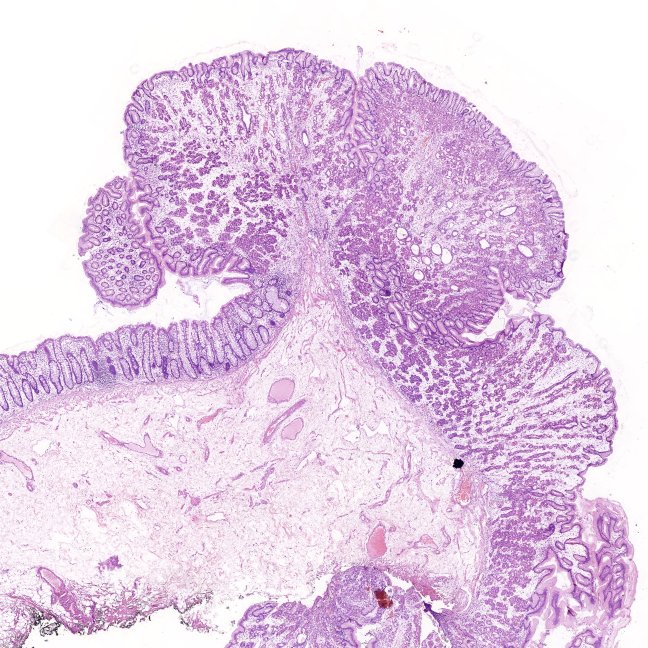 HLapsar's tweet image. Polypoid lesion of sigmoid colon.
Not a frequently seen one 🙃
#PathTwitter #GIpath #BeautyInBenign