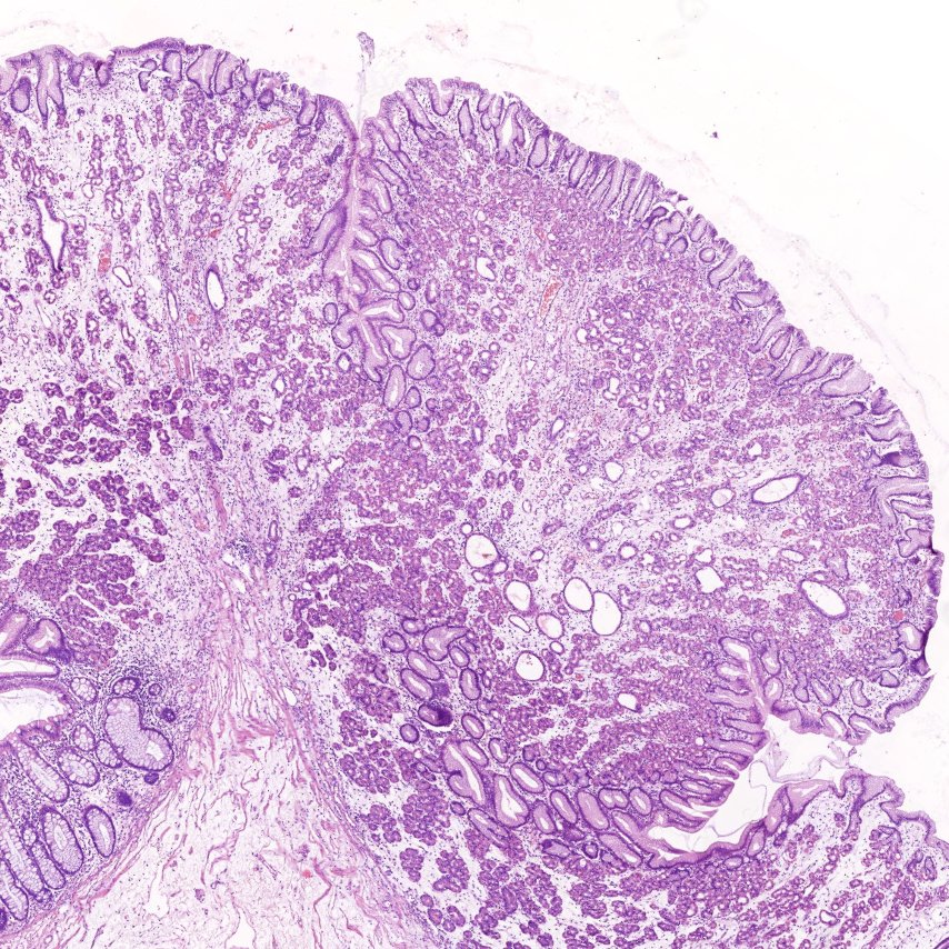 HLapsar's tweet image. Polypoid lesion of sigmoid colon.
Not a frequently seen one 🙃
#PathTwitter #GIpath #BeautyInBenign