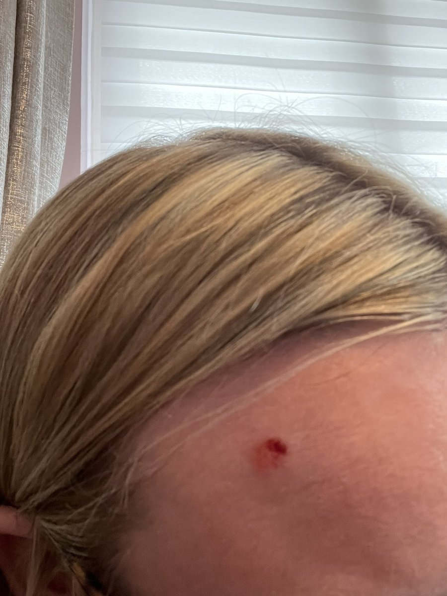 Sorry I’ve been quiet but I’ve had a lot going on.This isn’t a pity post,this is about raising awareness.This is skin cancer.I always thought you should look for changes in moles but it can look like this! They are going to cut it out,should be the end of it 🤞