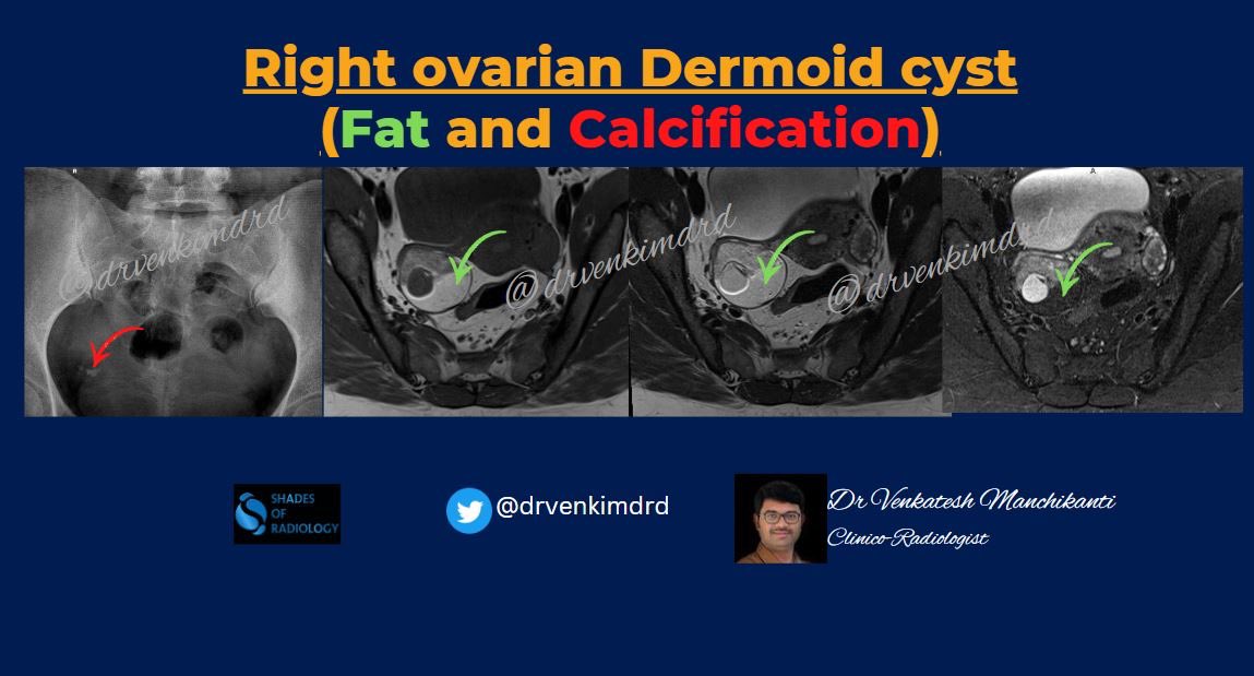 drvenkimdrd's tweet photo. Classic Dermoid cyst also showing classic Chemical shift artefact
@Radiology_Vibes @NehaYaduMD @FOAMradOrg @drdevrad @AnujAggarwal44 #FOAMrad #FOAMed #radiology #dermoid #chemicalshift https://t.co/b5cFG6PEl6