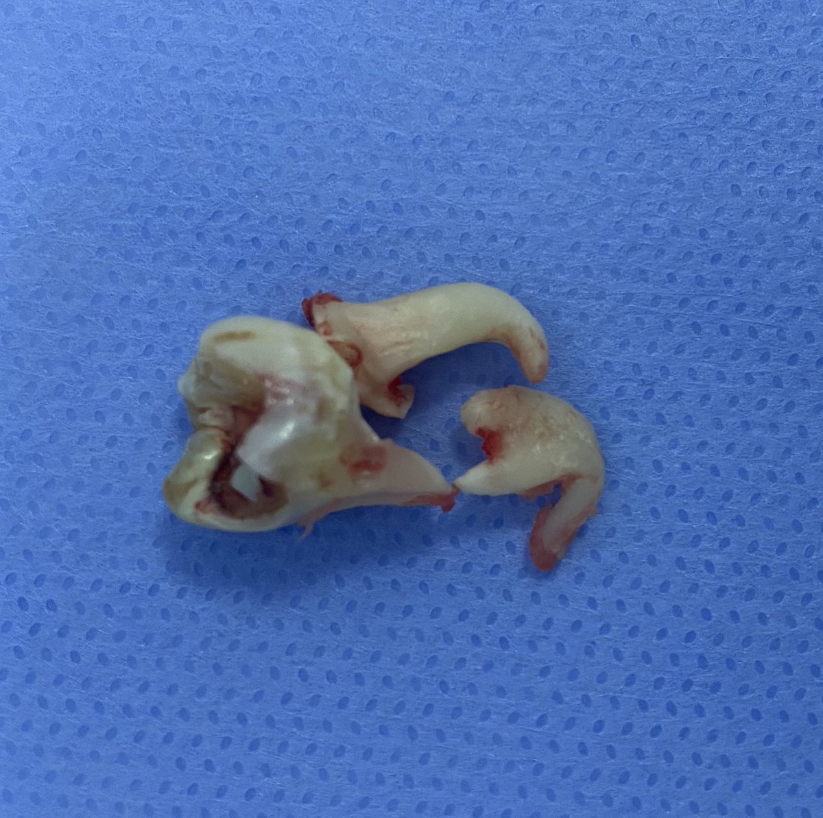 Almotreb's tweet photo. #omfs #dental
#oralSurgery
#thirdMolar https://t.co/vIOYlq9O3d