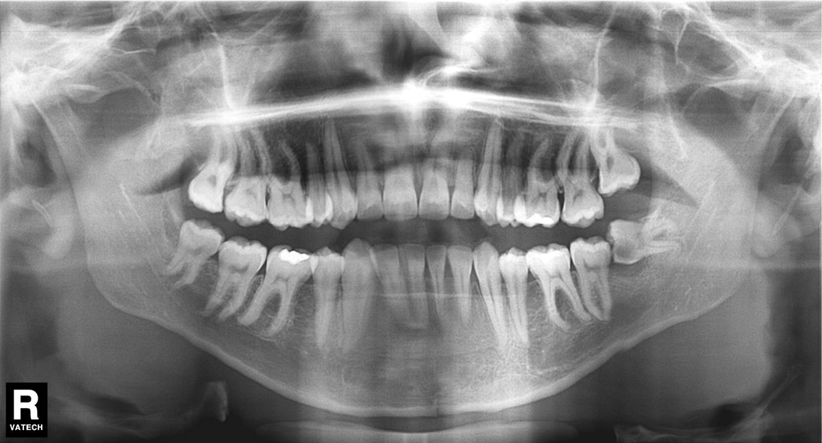 Almotreb's tweet photo. #omfs #dental
#oralSurgery
#thirdMolar https://t.co/vIOYlq9O3d