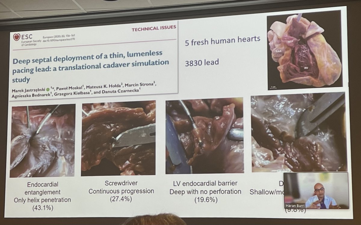 EuropaceEiC's tweet photo. A pleasure to be anchorperson of the #CRT #CSP and physiological pacing module of  #DAS_CAM_2021

Great discussion of a lot of #EUROPACE manuscript presented by @HaranBurri 

@ESC_Journals @escardio @kvernooy @harry_crijns @EHRAPresident @LuigiDiBiaseMD @natale_md @CarolRemme https://t.co/oG4Amipyd0