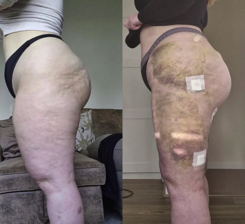 VaserDoc's tweet photo. Another great #BeforeAndAfter following a second procedure for our patient 🫶
She is battling #Lipoedema and is using #Liposuction as a way to #RemoveFat and manage the condition.
You can see the shape that has been created using liposuction below. ✨ https://t.co/HTcINW8PkM