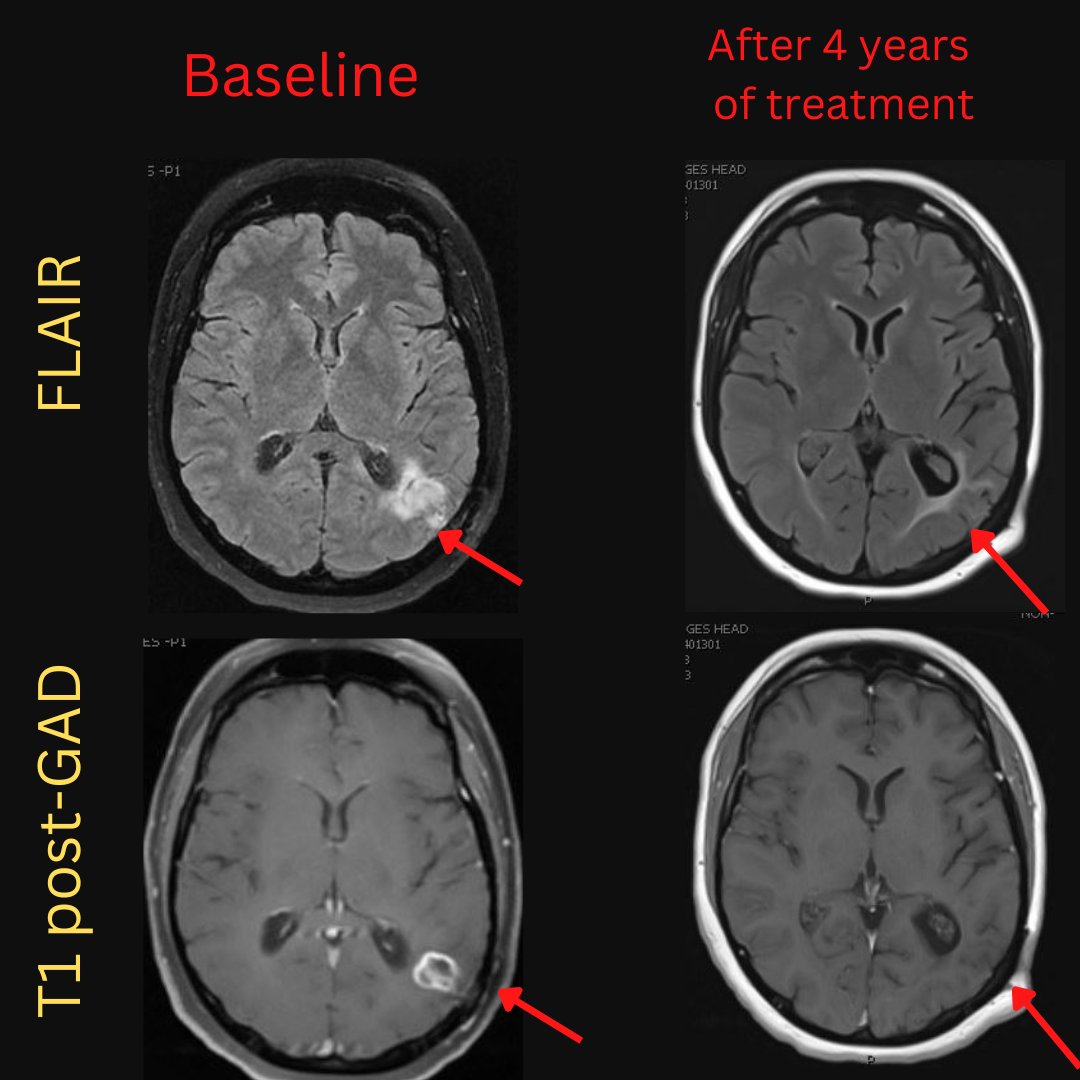 NeuroimagingN's tweet photo. Definite neurosarcoidosis
·
Another presentation of neurosarcoidosis. This time, it looks similar to an abscess. Biopsy showed noncaseating granulomas. After 4 years of treatment, there is a significant improvement in the lesion appearance.

#neurology #neurotwitter #MedTwitter https://t.co/5hhSgOMxwI