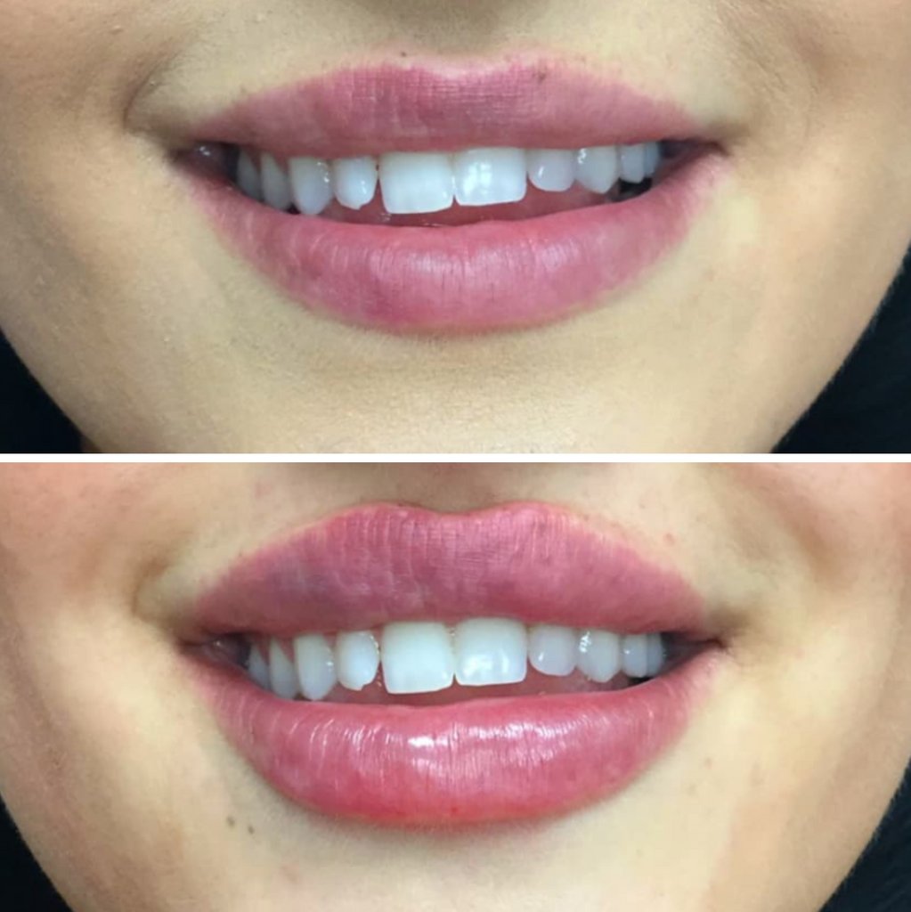 MD_Spa's tweet image. Contact us today:
Call: (780)9299797
Text: (780)9349021
DM: @MDSPALASER
Email: beaumont@mdspa.ca
Web: mdspa.ca

#edmonton #yeg #yeglocal #yegbusiness #alberta
#metime #beauty #wellness #selfcare #skin #acne #botox