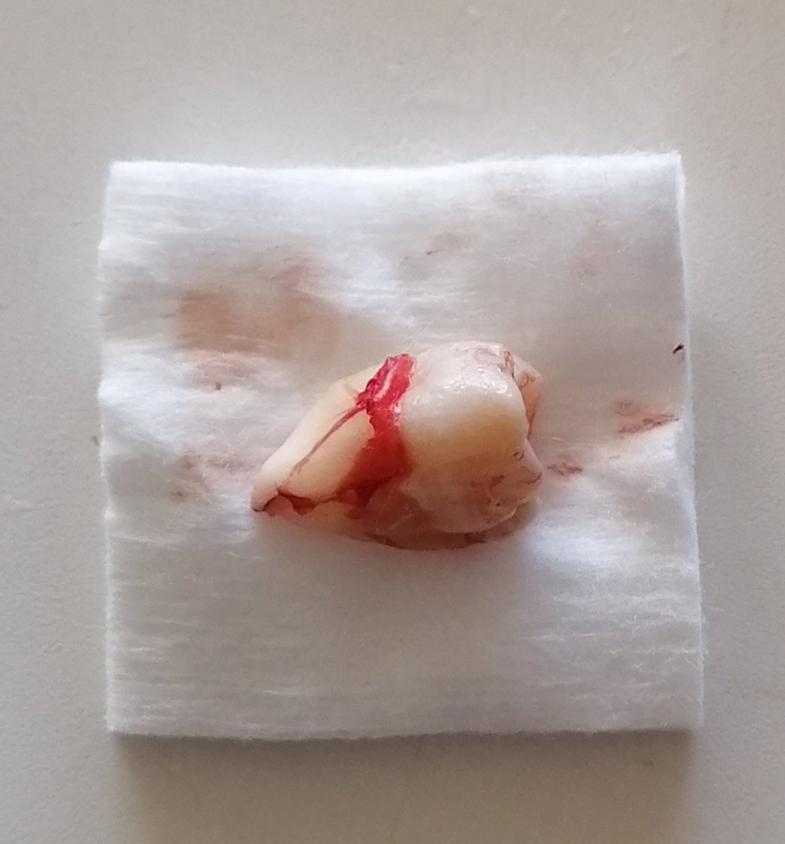 dds_sugano's tweet photo. 患者は20歳代の女性。他院に通院中なのだが、そこのDr.が抜歯の依頼という事で当院を訪れた。上顎左側第３大臼歯は上顎洞に近く、施術中に穿孔するおそれがある。確かに難症例である。
局所麻酔下で歯肉弁を切開剥離し、ゆっくりと慎重に抜歯した。時間は約20分。 https://t.co/LqQcKu7Ucu