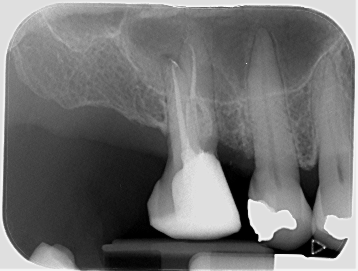 johnrhodesendo's tweet photo. One year review of RCT UR6 with MB root resection doing well, symptom and sign free and beautifully restored by the referring dentist 😁
#savingteeth #endodontics

https://t.co/vHPhP6Grbs https://t.co/JHqPustPmm