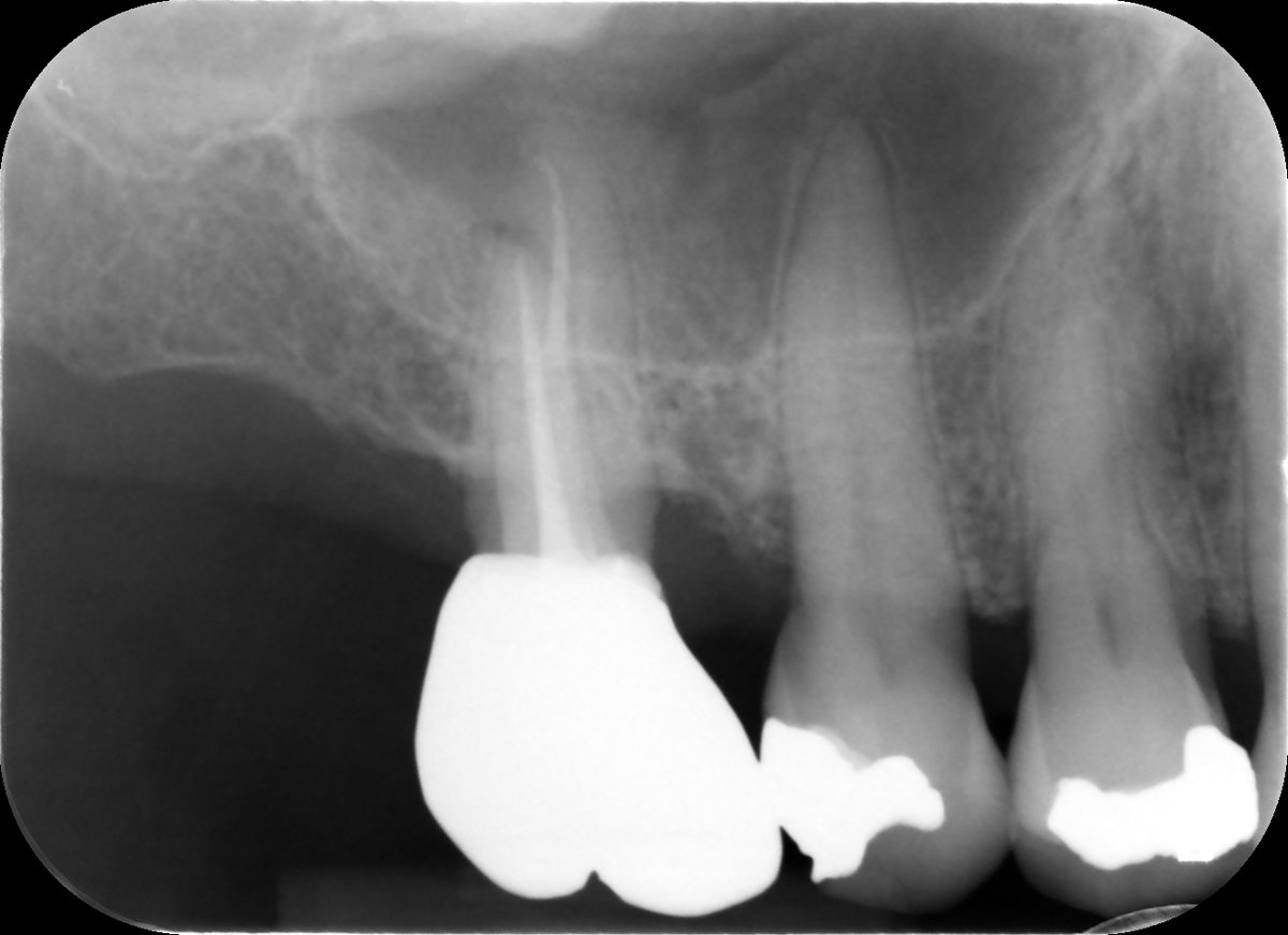 One year review of RCT UR6 with MB root resection doing well, symptom and sign free and beautifully restored by the referring dentist 😁
#savingteeth #endodontics

youtu.be/pgO5aFGDeI4