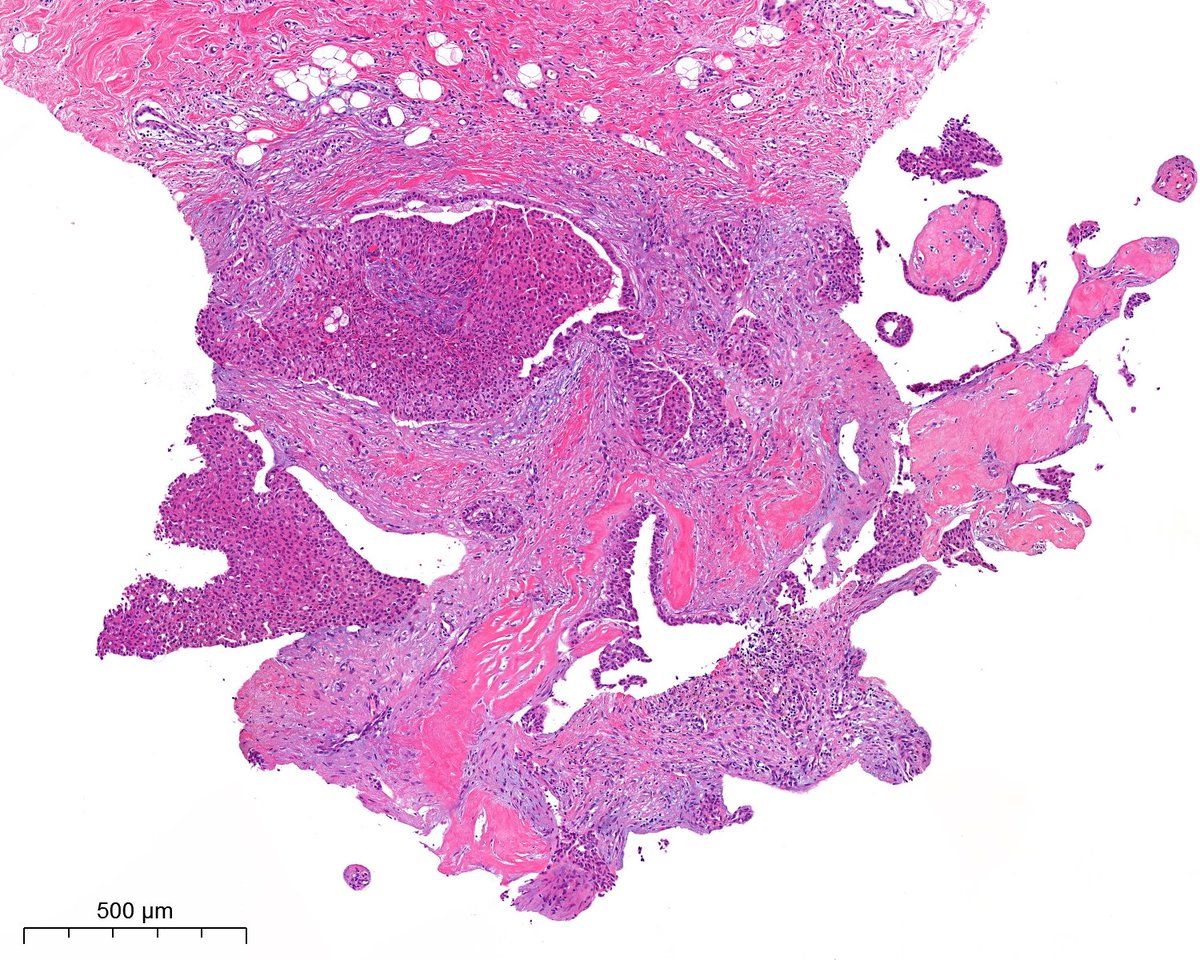 A. Polónia (@poloniaantonio) on Twitter photo F, middle-age, breast nodule, VAB 😃 I know, it´s super tricky!!! #breastpath <a href="/atman_ci/">Dr. Luca</a> <a href="/ADamronMD/">Alexander Damron, MD</a> <a href="/LizaMQuintana/">Liza Quintana, MD</a> <a href="/AGrabenstetter/">Anne Grabenstetter</a> <a href="/DrGeeONE/">Olaleke Folaranmi</a> <a href="/tlabiano/">Tania Labiano</a> <a href="/AmPathology/">Ana Marques</a> <a href="/jennpincus/">Jenny Pincus, MD</a> <a href="/ariella8/">Celina Stayerman MD</a> <a href="/nusrat_xahra/">🔻Nusrat Zahra🔻🇵🇸</a> @miss_me1986 <a href="/gonzadetoro/">Gonzalo De Toro</a> <a href="/TristanRutland7/">Tristan Rutland MBBS FRCPA IFCAP</a> <a href="/LoboAnandi/">Anandi Lobo, MD</a> <a href="/JPintoPath/">João Correia Pinto</a> <a href="/EloyCatarina/">Catarina Eloy, MD,PhD</a> F, middle-age, breast nodule, VAB 😃 I know, it´s super tricky!!! #breastpath <a href="/atman_ci/">Dr. Luca</a> <a href="/ADamronMD/">Alexander Damron, MD</a> <a href="/LizaMQuintana/">Liza Quintana, MD</a> <a href="/AGrabenstetter/">Anne Grabenstetter</a> <a href="/DrGeeONE/">Olaleke Folaranmi</a> <a href="/tlabiano/">Tania Labiano</a> <a href="/AmPathology/">Ana Marques</a> <a href="/jennpincus/">Jenny Pincus, MD</a> <a href="/ariella8/">Celina Stayerman MD</a> <a href="/nusrat_xahra/">🔻Nusrat Zahra🔻🇵🇸</a> @miss_me1986 <a href="/gonzadetoro/">Gonzalo De Toro</a> <a href="/TristanRutland7/">Tristan Rutland MBBS FRCPA IFCAP</a> <a href="/LoboAnandi/">Anandi Lobo, MD</a> <a href="/JPintoPath/">João Correia Pinto</a> <a href="/EloyCatarina/">Catarina Eloy, MD,PhD</a>