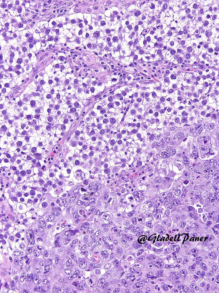 GladellPaner's tweet photo. Germ cell tumor of #testis contrasting:

Top: Seminona - clear cells with distinct membrane, fibrous septa, and lymphocytic infiltrates.

Bottom: Embryonal carcinoma - markedly pleomorphic tumor cells.

No IHC please. #GUPath https://t.co/Od2CRwJuHN