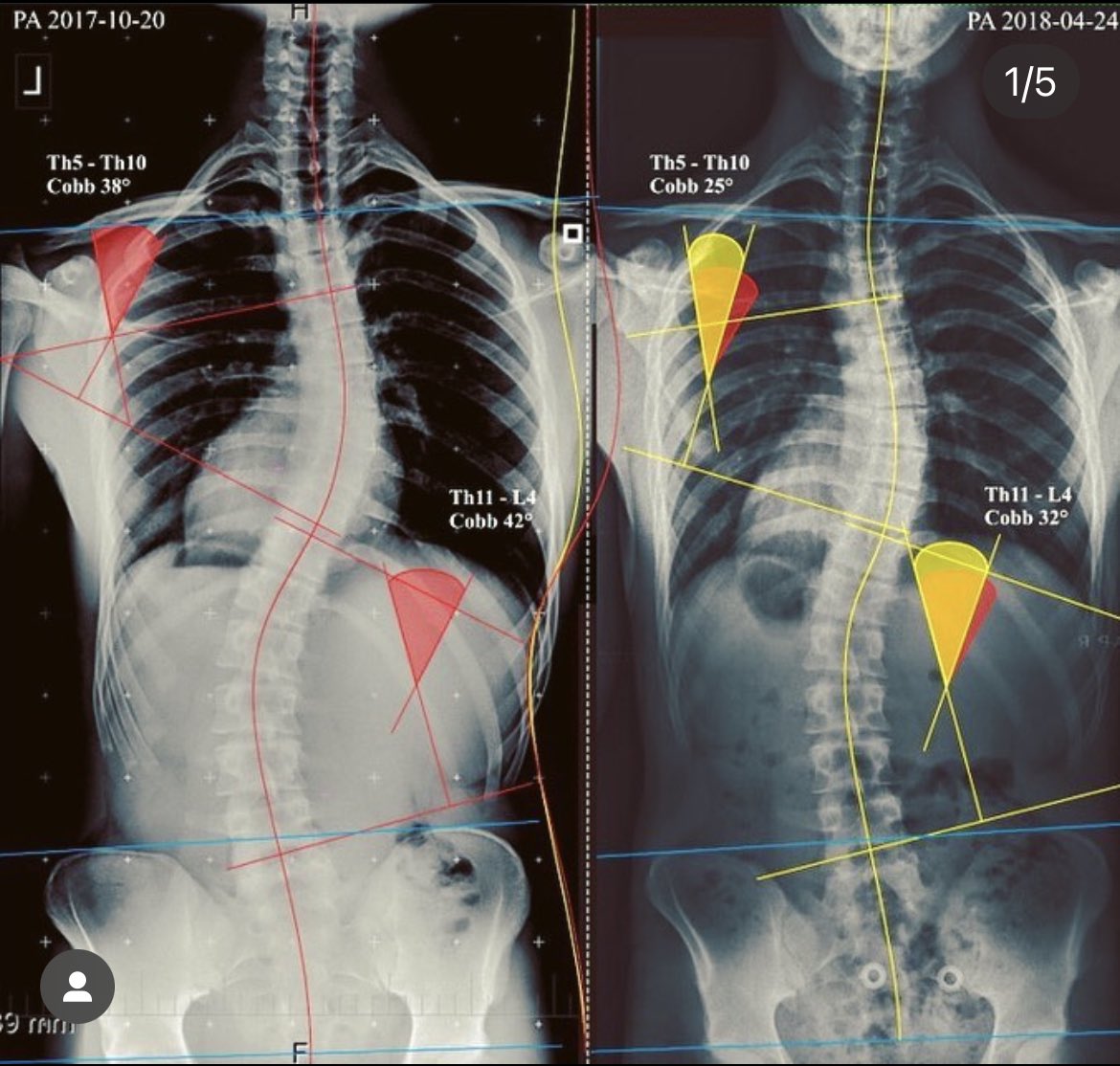 Spiral Stabilization tweet media