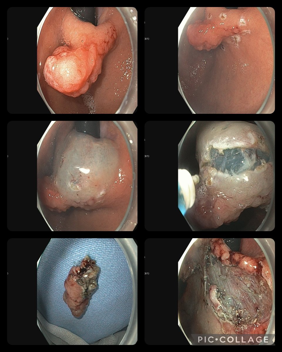 doc_zubin's tweet image. ESD for Early Gastric Malignancy. All Margins free. Difficult due to position of lesion and limited scope movements. All resection in retroversion... #GITwitter #Thirdspace #Gastroenterology