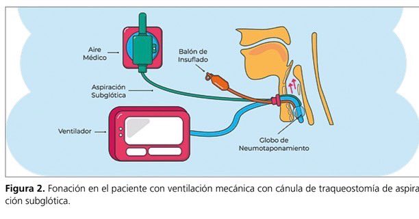 Benito Parra Maldonado (@benitoparramal1) on Twitter photo Me da mucha ilusión compartirles este artículo de revisión pues no es solo para el personal de la salud si no también para los familiares que viven con un paciente con traqueostomia. <a href="/chileanestesia/">Editora Revista Chilena de Anestesia</a> muchas gracias 🫶 Me da mucha ilusión compartirles este artículo de revisión pues no es solo para el personal de la salud si no también para los familiares que viven con un paciente con traqueostomia. <a href="/chileanestesia/">Editora Revista Chilena de Anestesia</a> muchas gracias 🫶
